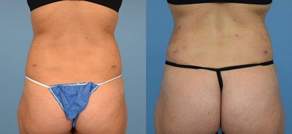 Photo of the patient’s body before & after the Liposuction surgery. Set 4: Patient 9