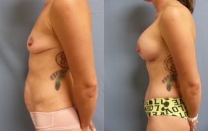 Mommy Makeover Before & After Patient Miniature Set
