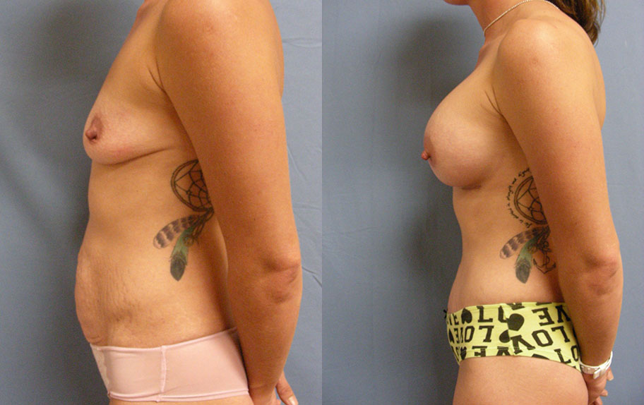 Photo of the patient’s body before & after the Mommy Makeover surgery. Set 2: Patient 1