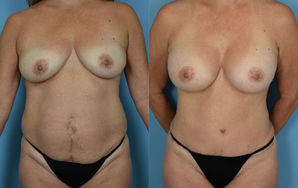 Photo of the patient’s body before & after the Mommy Makeover surgery. Set 2: Patient 2
