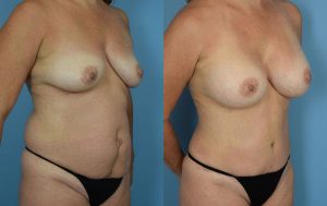 Mommy Makeover Before & After Patient Miniature Set