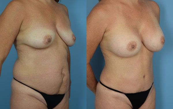 Photo of the patient’s body before & after the Mommy Makeover surgery. Set 2: Patient 2