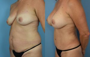 Mommy Makeover Before & After Patient Miniature Set