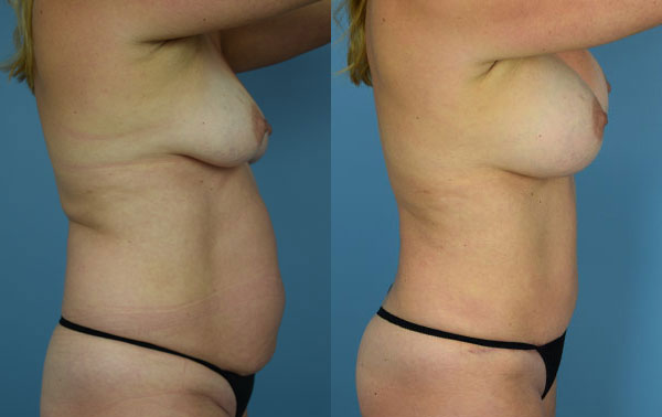 Photo of the patient’s body before & after the Mommy Makeover surgery. Set 4: Patient 2