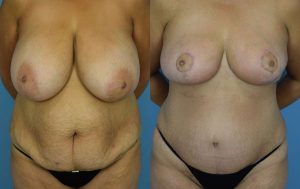 Mommy Makeover Before & After Patient Miniature Set