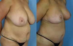 Mommy Makeover Before & After Patient Miniature Set