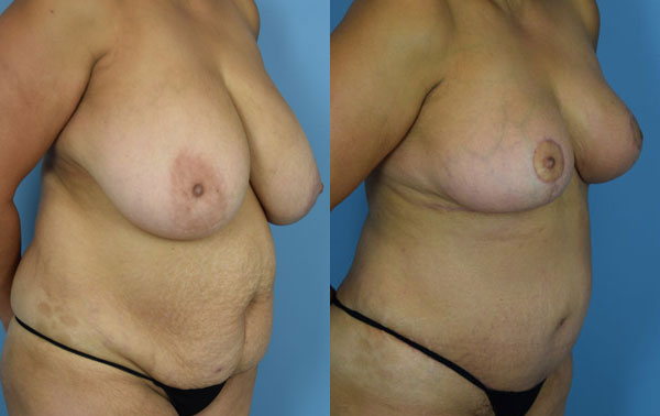 Photo of the patient’s body before & after the Mommy Makeover surgery. Set 2: Patient 11
