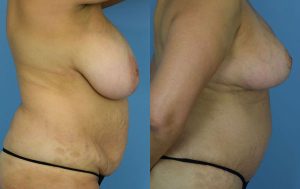 Mommy Makeover Before & After Patient Miniature Set