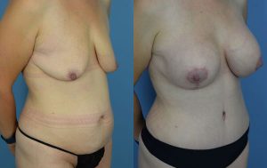 Mommy Makeover Before & After Patient Miniature Set