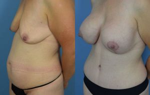 Mommy Makeover Before & After Patient Miniature Set