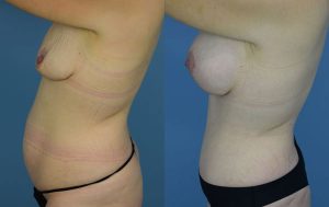 Mommy Makeover Before & After Patient Miniature Set