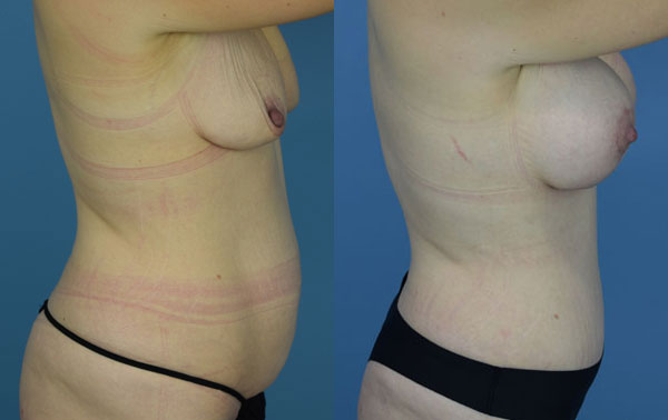Photo of the patient’s body before & after the Mommy Makeover surgery. Set 4: Patient 12