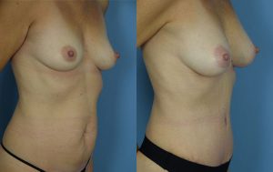 Mommy Makeover Before & After Patient Miniature Set