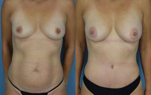 Mommy Makeover Before & After Patient Miniature Set