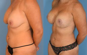 Mommy Makeover Before & After Patient Miniature Set