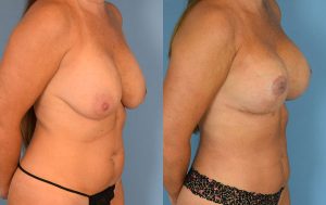 Mommy Makeover Before & After Patient Miniature Set