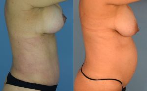Mommy Makeover Before & After Patient Miniature Set
