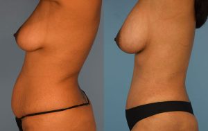 Mommy Makeover Before & After Patient Miniature Set