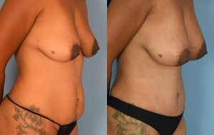 Mommy Makeover Before & After Patient Miniature Set