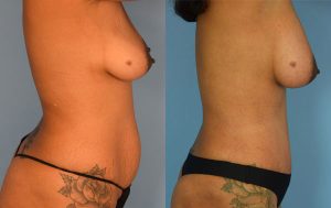 Mommy Makeover Before & After Patient Miniature Set