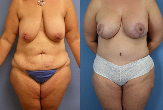 Photo of the patient’s body before & after the Mommy Makeover surgery. Set 1: Patient 5