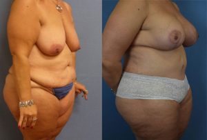 Mommy Makeover Before & After Patient Miniature Set