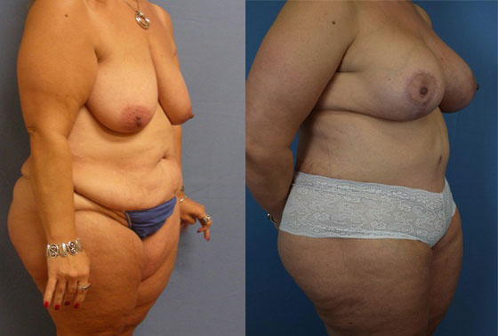 Photo of the patient’s body before & after the Mommy Makeover surgery. Set 2: Patient 5