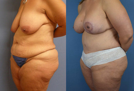 Photo of the patient’s body before & after the Mommy Makeover surgery. Set 3: Patient 5