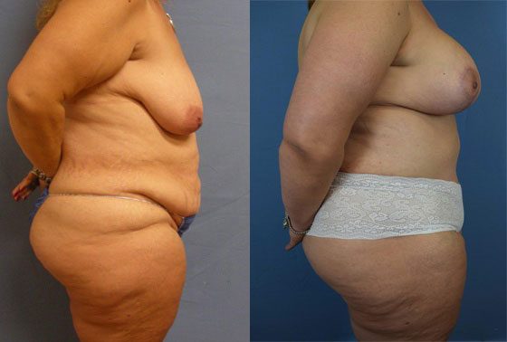 Photo of the patient’s body before & after the Mommy Makeover surgery. Set 4: Patient 5