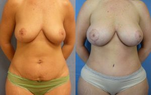 Mommy Makeover Before & After Patient Miniature Set