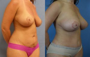 Mommy Makeover Before & After Patient Miniature Set