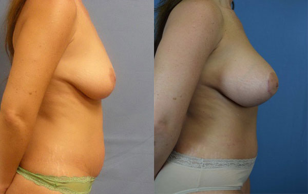 Photo of the patient’s body before & after the Mommy Makeover surgery. Set 3: Patient 6