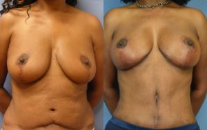 Mommy Makeover Before & After Patient Miniature Set