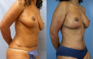 Mommy Makeover Before & After Patient Miniature Set