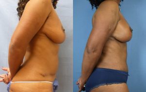 Mommy Makeover Before & After Patient Miniature Set