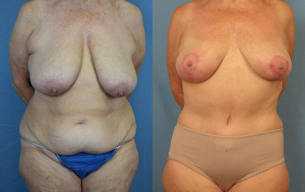 Photo of the patient’s body before & after the Mommy Makeover surgery. Set 1: Patient 3