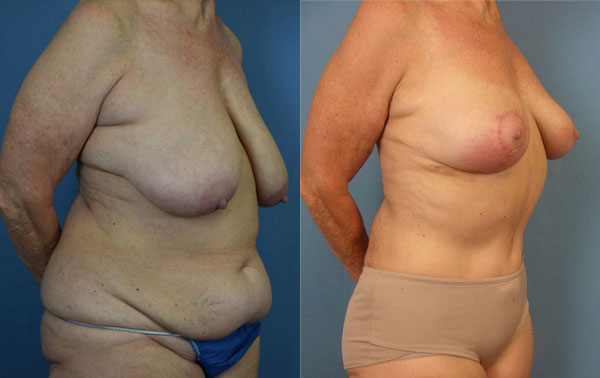 Photo of the patient’s body before & after the Mommy Makeover surgery. Set 2: Patient 3