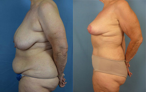 Photo of the patient’s body before & after the Mommy Makeover surgery. Set 3: Patient 3