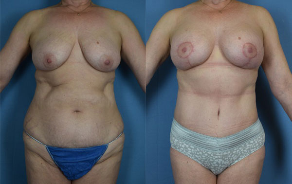 Photo of the patient’s body before & after the Mommy Makeover surgery. Set 1: Patient 4