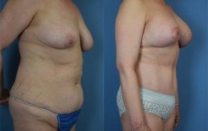 Mommy Makeover Before & After Patient Miniature Set