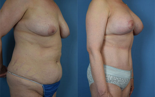 Photo of the patient’s body before & after the Mommy Makeover surgery. Set 2: Patient 4