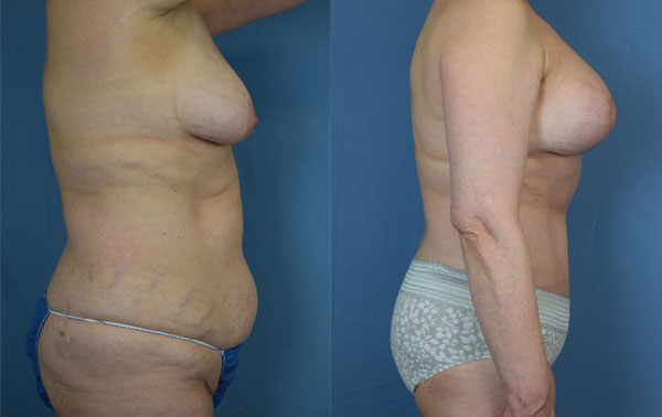 Photo of the patient’s body before & after the Mommy Makeover surgery. Set 3: Patient 4