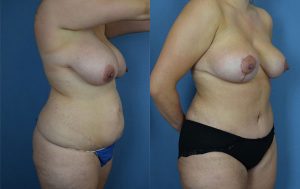 Mommy Makeover Before & After Patient Miniature Set