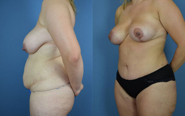 Photo of the patient’s body before & after the Mommy Makeover surgery. Set 3: Patient 8