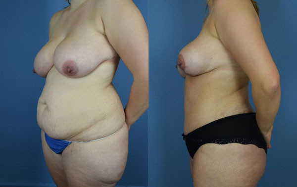 Photo of the patient’s body before & after the Mommy Makeover surgery. Set 4: Patient 8