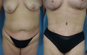 Mommy Makeover Before & After Patient Miniature Set