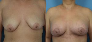 Mommy Makeover Before & After Patient Miniature Set