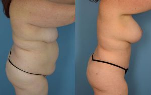 Mommy Makeover Before & After Patient Miniature Set
