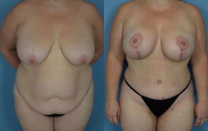 Mommy Makeover Before & After Patient Miniature Set