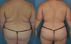 Mommy Makeover Before & After Patient Miniature Set